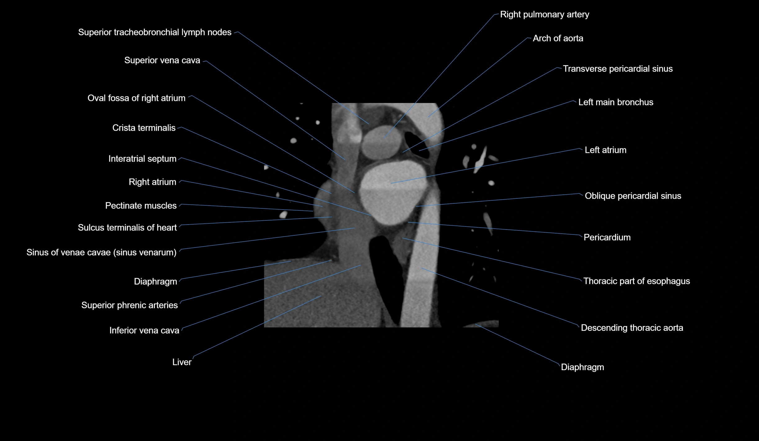 CT heart (coronary angiogram) short axis view  cross sectional anatomy labelled radiology image-00011.webp